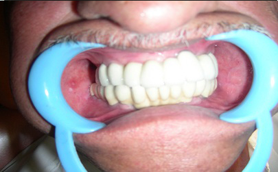 Full Mouth Implants