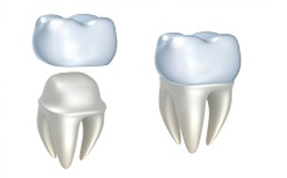 Fix Broken teeth & Cavities Crown