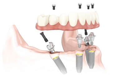 All On 4 dental implants