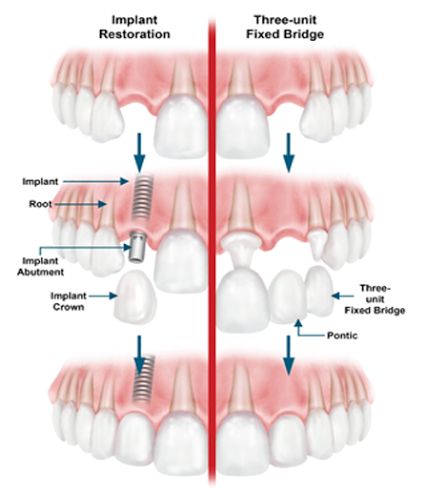 Replacing Missing Teeth
