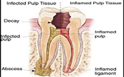 Root Canal Treatment (R.C.T)