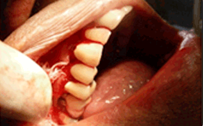 Management of implant complications